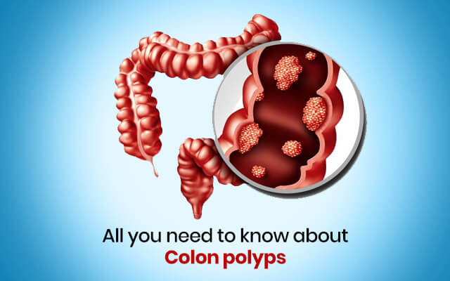 Colon polyps