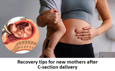 Recovery tips for new mothers after C-section delivery