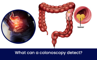 What can a colonoscopy detect