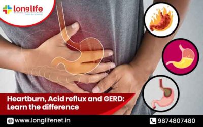 Heartburn, Acid reflux and GERD: Learn the difference