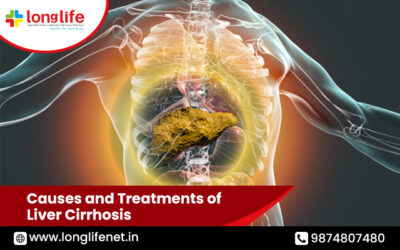 Causes and Treatments of Liver Cirrhosis