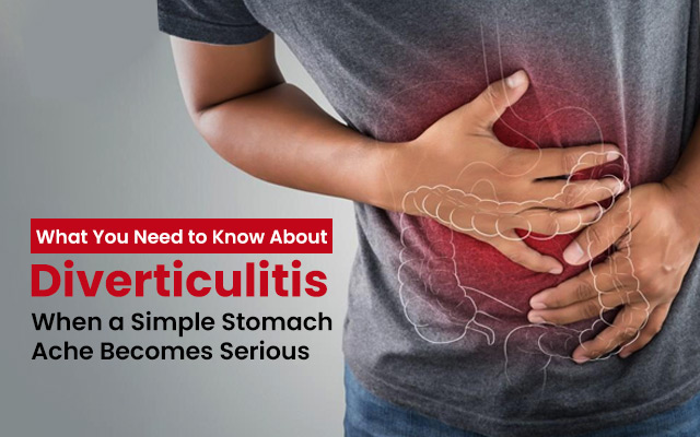 What You Need to Know About Diverticulitis: When a Simple Stomach Ache Becomes Serious